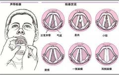 重庆耳鼻喉-声带息肉的症状